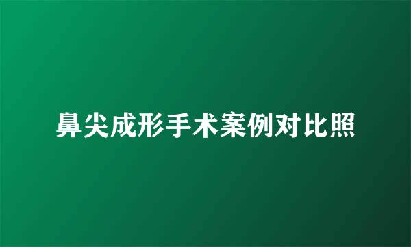 鼻尖成形手术案例对比照